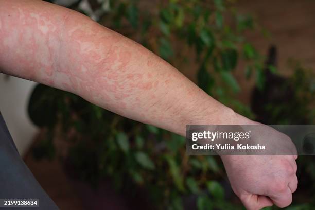 Okra Rash 32 Food Allergy Rash Stock Photos, High-Res Pictures, and Images ...