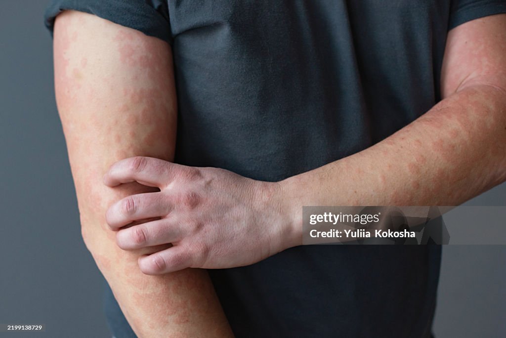 Allergy Awareness. Atopic dermatitis, a red, inflamed, scaly rash