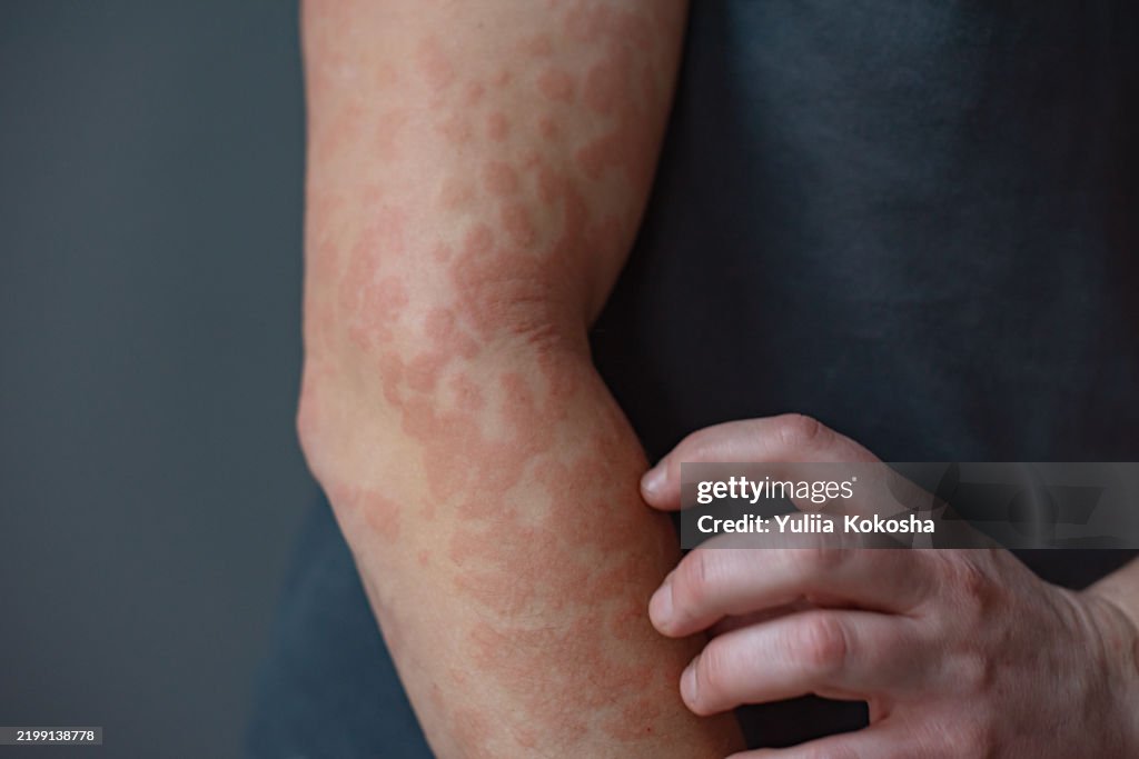 Close-up view , covered in red, itchy rash with fingers frantically scratching inflamed skin
