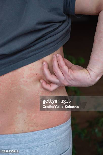 Bumpy Rash From Food 32 Food Allergy Rash Stock Photos, High-Res Pictures, and Images ...