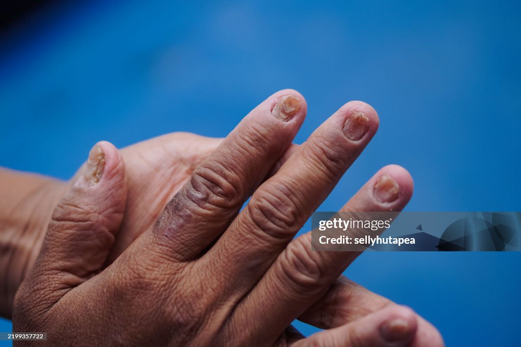Hand with Recovering Fungal Nail Infection