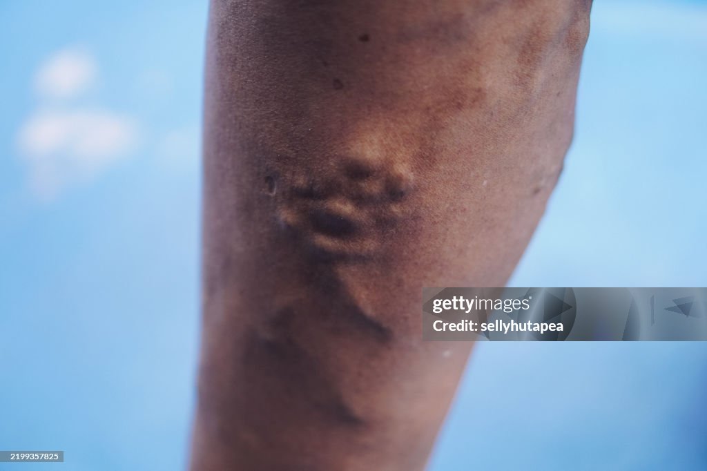 Close-up of a Human Leg with Skin Inflammation and Varicose Veins