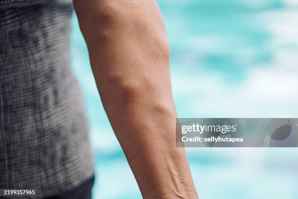 close-up of a human arm with varicose veins and vascular texture - ådernät bildbanksfoton och bilder