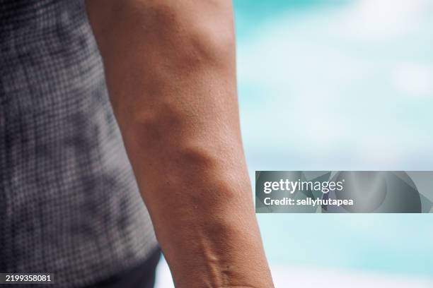 close-up of a human arm with varicose veins and vascular texture - ådernät bildbanksfoton och bilder