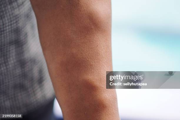 close-up of a human arm with varicose veins and vascular texture - ådernät bildbanksfoton och bilder