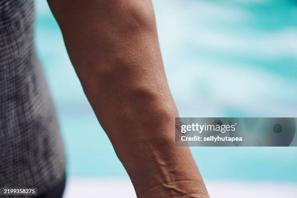close-up of a human arm with varicose veins and vascular texture - ådernät bildbanksfoton och bilder