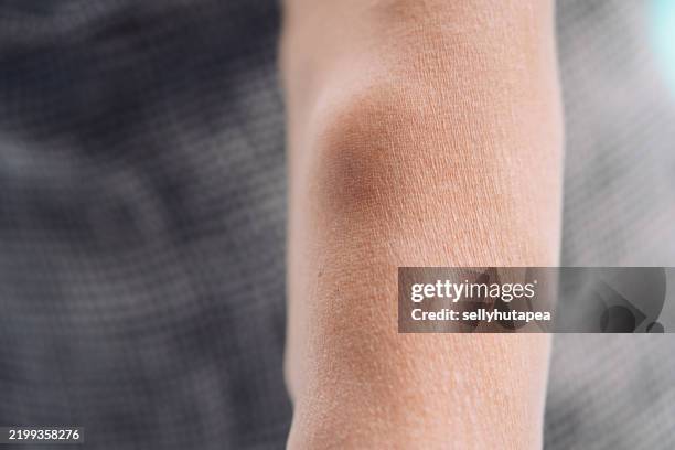 close-up of a human arm with varicose veins and vascular texture - ådernät bildbanksfoton och bilder