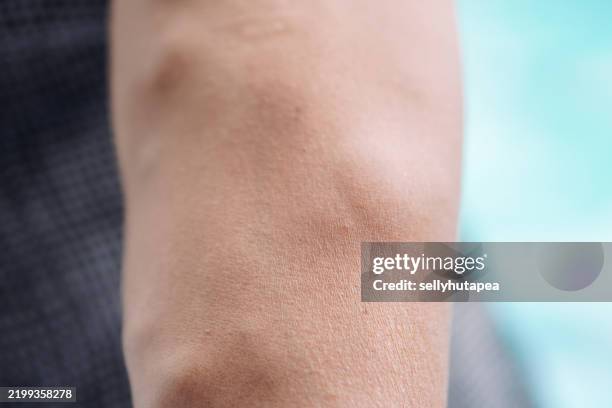 close-up of a human arm with varicose veins and vascular texture - ådernät bildbanksfoton och bilder