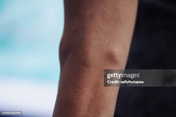 close-up of a human arm with varicose veins and vascular texture - ådernät bildbanksfoton och bilder