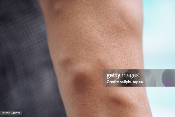 close-up of a human arm with varicose veins and vascular texture - ådernät bildbanksfoton och bilder