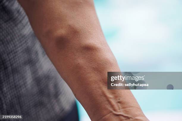 close-up of a human arm with varicose veins and vascular texture - ådernät bildbanksfoton och bilder
