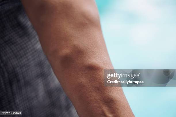 close-up of a human arm with varicose veins and vascular texture - ådernät bildbanksfoton och bilder