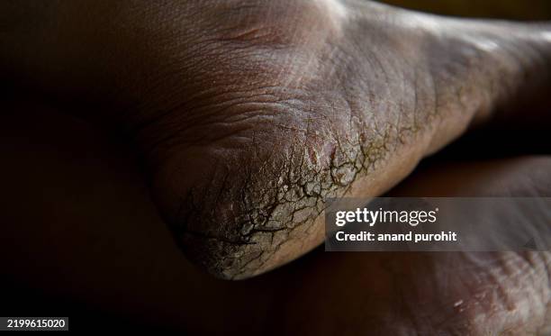 Chapped Legs 225 Leg Dermatitis Stock Photos, High-Res Pictures, and Images - Getty ...