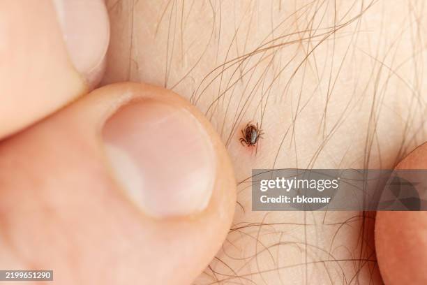 tick bites human skin. dangerous parasitic insect attached to body among hair - tique à pattes noires photos et images de collection