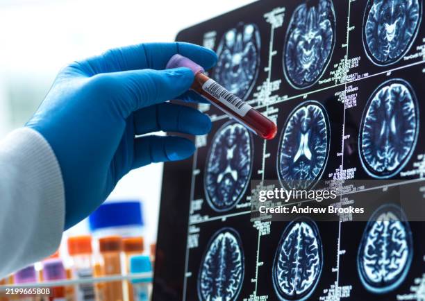 neurology research,patients blood sample being checked against the medical scan during a clinical trial - alzheimer imagens e fotografias de stock