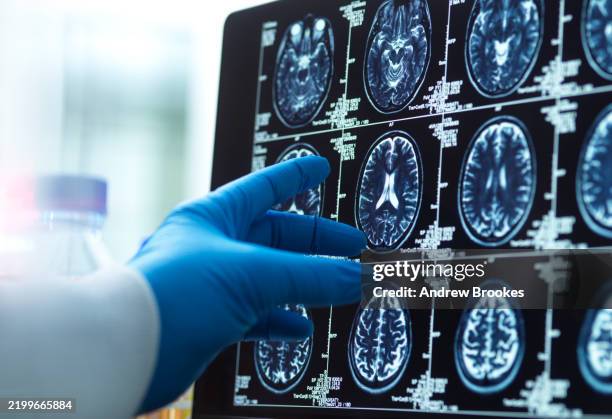 doctor viewing a brain scan for possible ageing and disease - patient stock pictures, royalty-free photos & images
