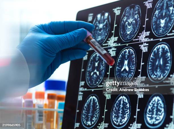 neurology research,patients blood sample being checked against the medical scan during a clinical trial - medical examination stock pictures, royalty-free photos & images