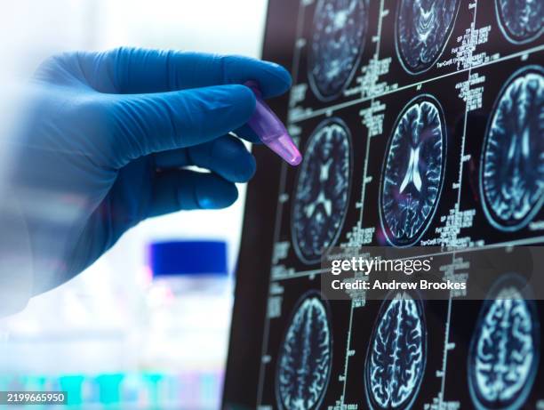 dementia and alzhiemer's research, scientist preparing human sample during a clinical trial - eeg stock-fotos und bilder