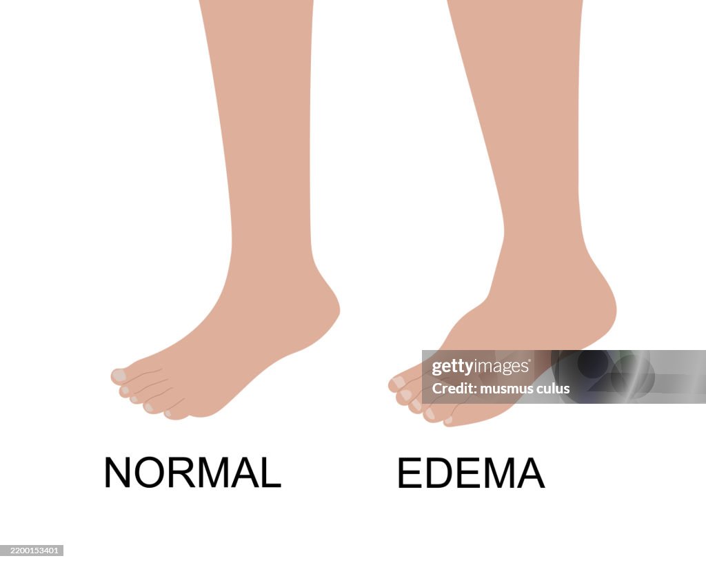 Healthy and edematous feet