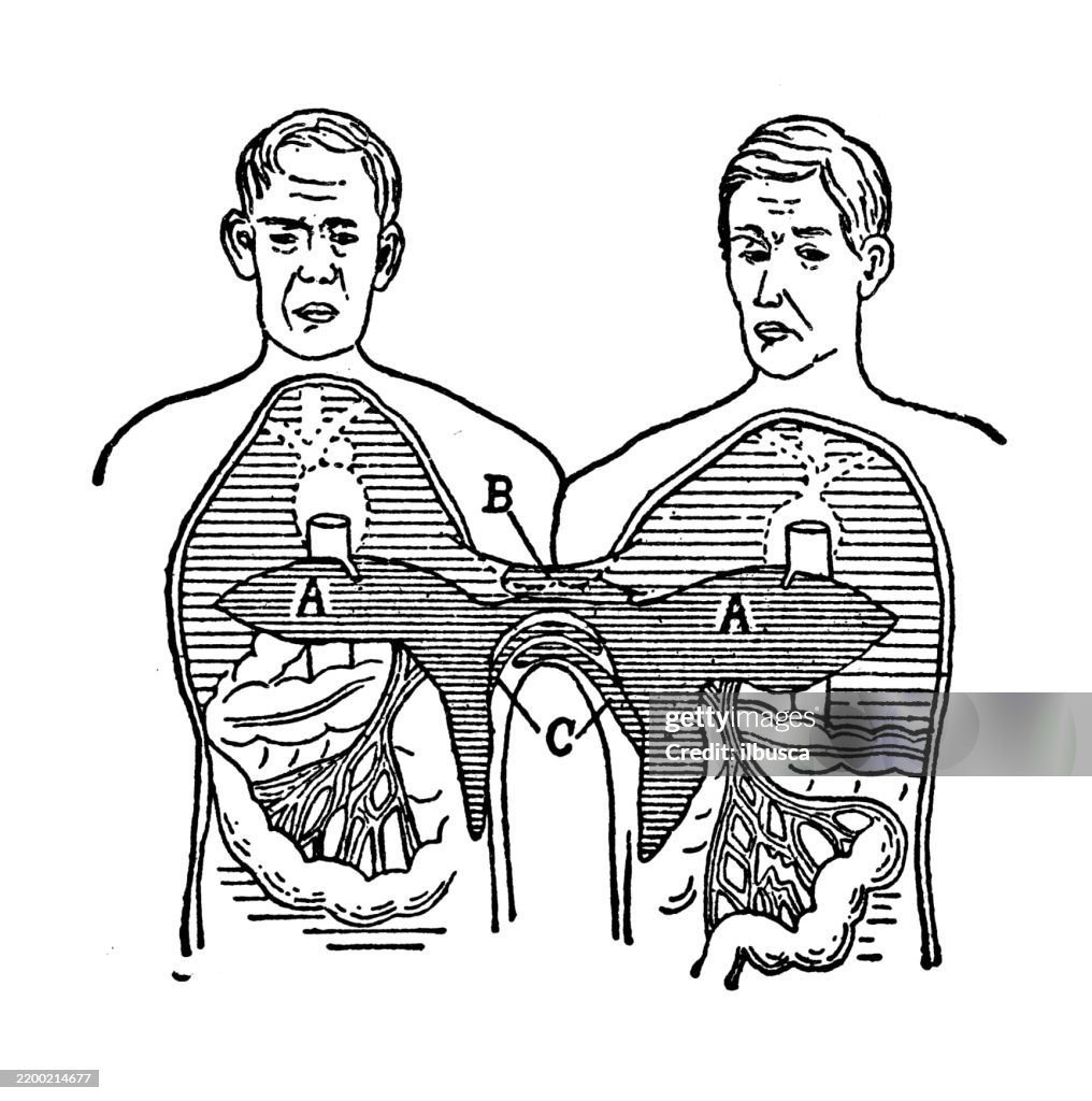 Siamese or Conjoined Twins, Omphalopagus