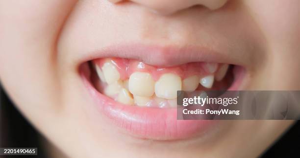 caries infantiles y dientes torcidos - encorvado fotografías e imágenes de stock