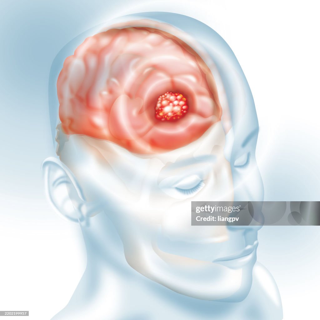 Brain Cancer Animation Brain Cancer High-Res Vector Graphic - Getty Images