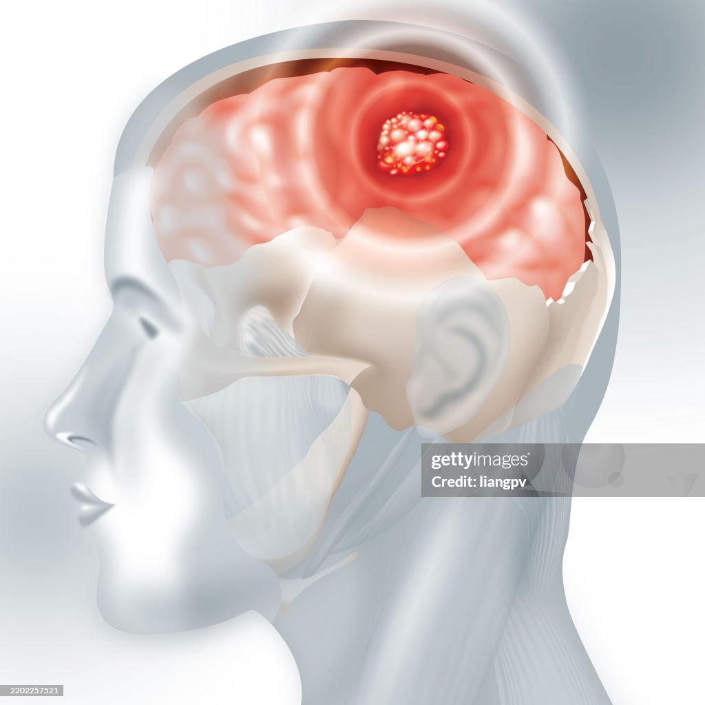 Brain Cancer Animation Brain Cancer High-Res Vector Graphic - Getty Images