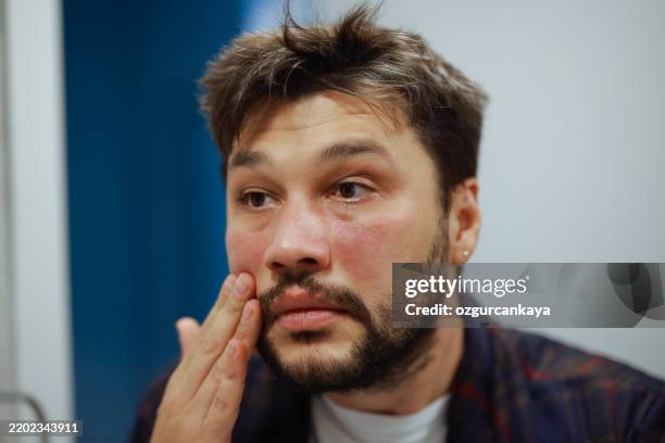 homme présentant une réaction allergique sévère sur la peau du visage. - irritation cutanée photos et images de collection