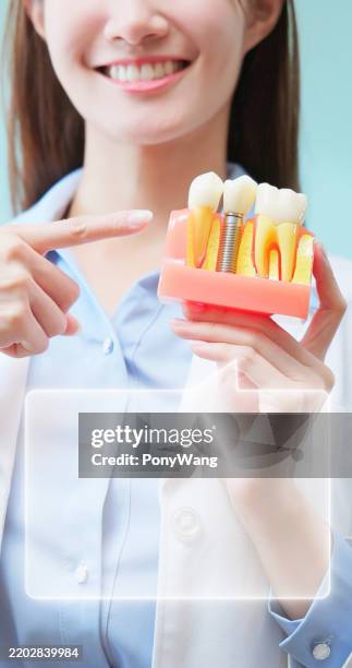 asian dentist holds implant model - implante dentário imagens e fotografias de stock