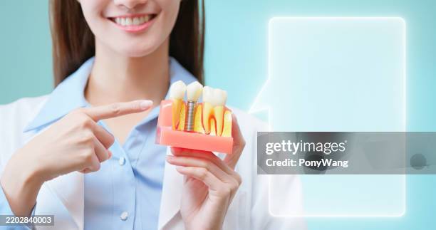 asian dentist holds implant model - implante dentário imagens e fotografias de stock