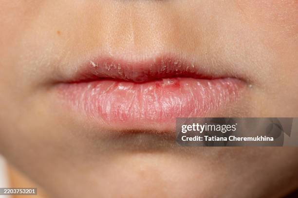 chapped children's lips, close-up - lippen stock-fotos und bilder