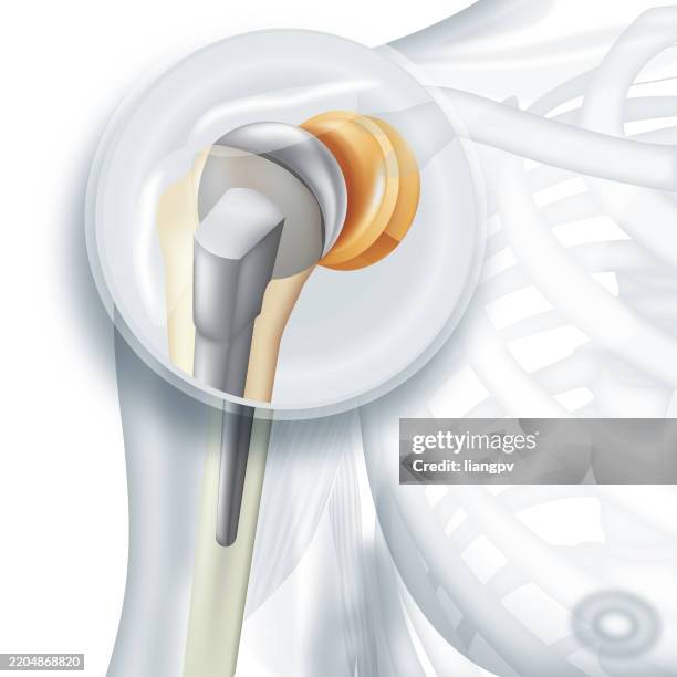 shoulder replacement - shoulder bone stock illustrations