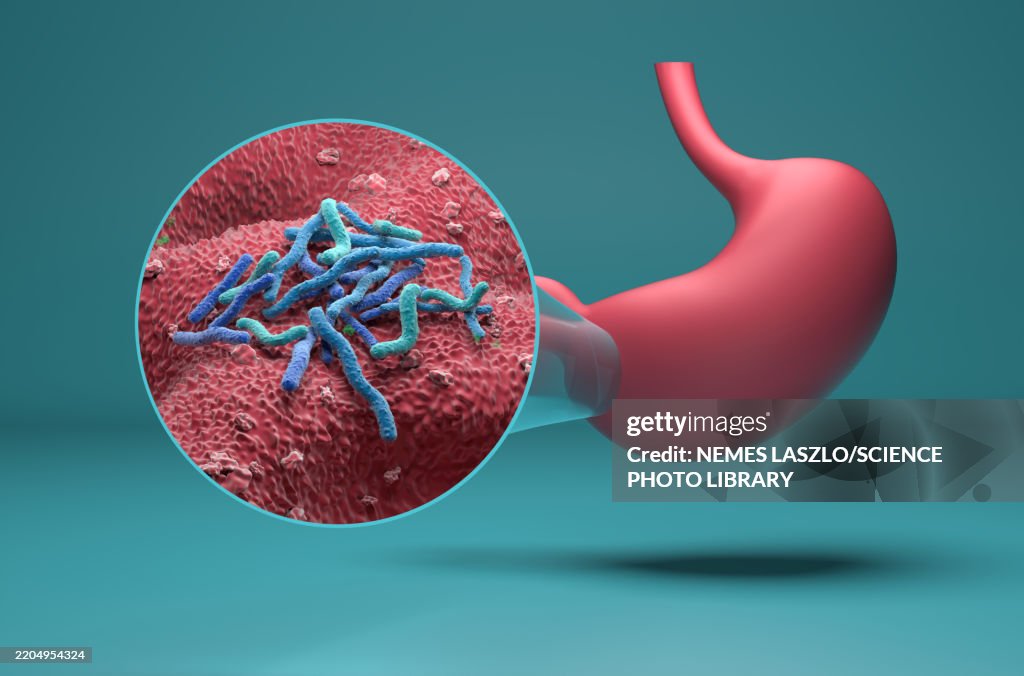 Helicobacter pylori infection, illustration