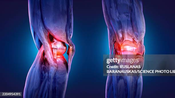stockillustraties, clipart, cartoons en iconen met painful knees, conceptual illustration - kraakbeen