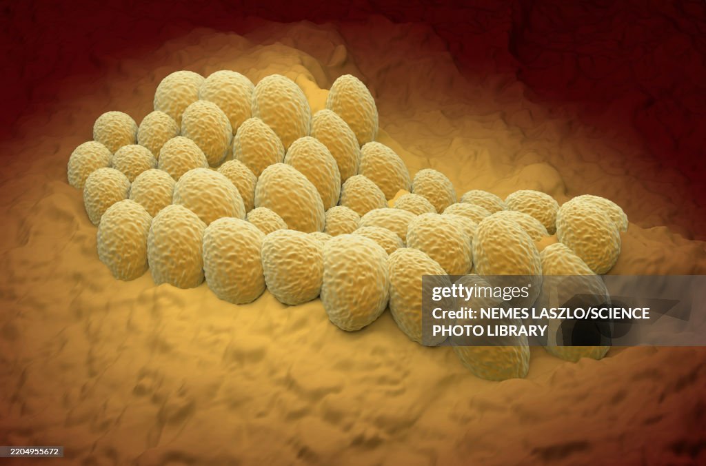 Endometrial cancer, illustration