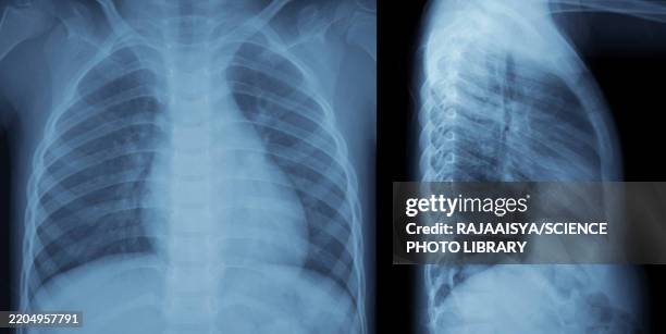 healthy chest and lungs, x-rays - imagem de raios x imagens e fotografias de stock