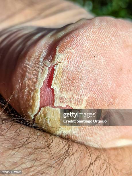 close-up of heel peeling off due to vasculitis - autoimmune disease stock pictures, royalty-free photos & images