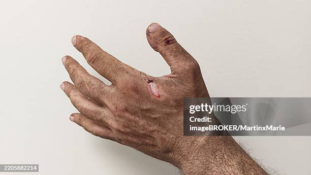 Grinding Injury 53 Machine Hand Injury Stock Photos, High-Res Pictures, and Images ...