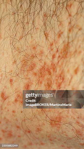 Bumpy Rash From Food 32 Food Allergy Rash Stock Photos, High-Res Pictures, and Images ...
