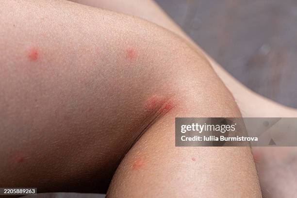 Insect Bite Rash Leg 148 Dermatitis Leg Stock Photos, High-Res Pictures, and Images - Getty ...