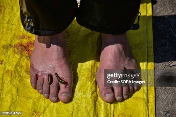 Patient receives leech therapy on his feet on Nowruz, the day which marks the first day of spring and the beginning of the year in the Persian...