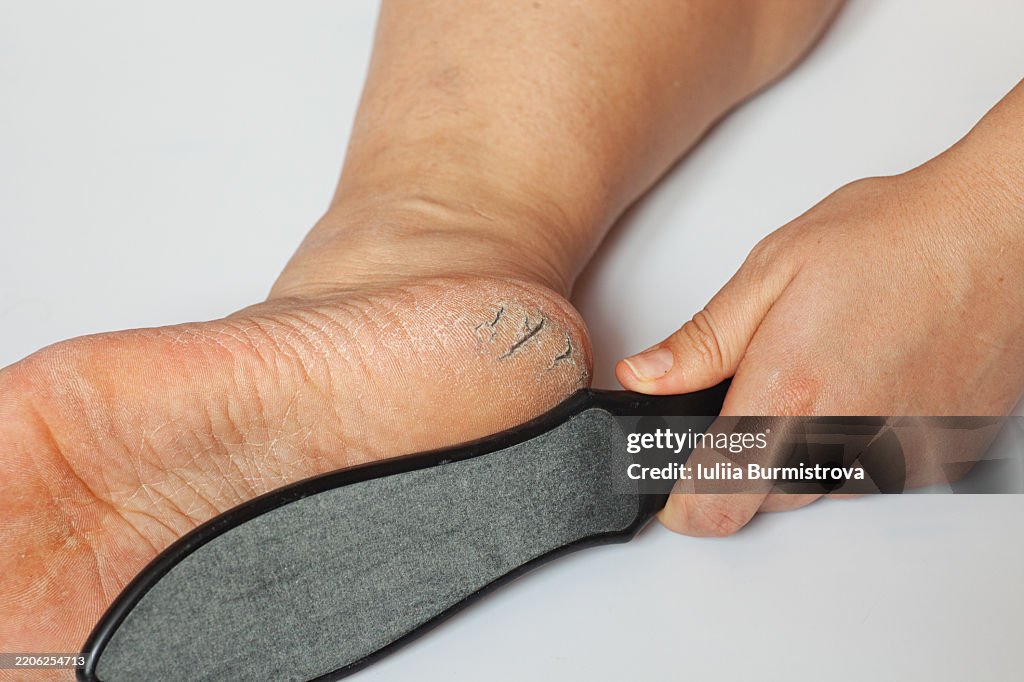Foot Care Using a File for Removing Dry and Cracked Skin on Soles