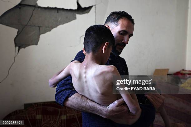 Mohammed Hanieh, a thirteen-year-old Palestinian boy who his family says suffers from malnutrition, is carried by father at his family home in the...