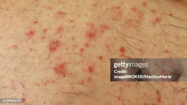 Extensive Red Rash 75 Red Skin Rash Stock Photos, High-Res Pictures, and Images - Getty Images