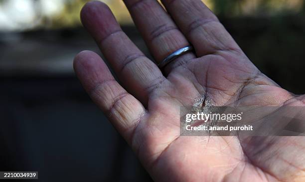 palm psoriasis or hand eczema - agent pathogène fongique photos et images de collection