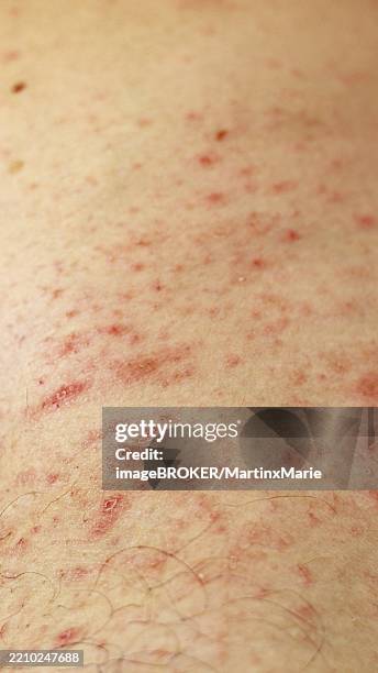 Skin Rash Red Color 75 Red Skin Rash Stock Photos, High-Res Pictures, and Images - Getty Images