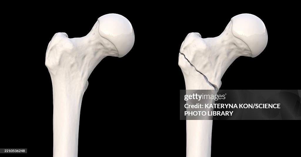 Intertrochanteric Femur Fracture Illustration High Res Vector Graphic intertrochanteric-femur-fracture-illustration-high-res-vector-graphic