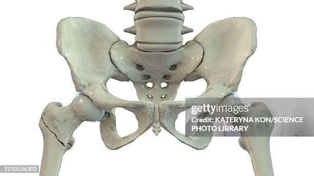 intertrochanteric femur fracture, illustration - hip body part stock illustrations