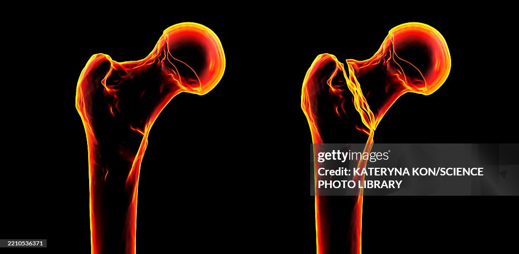 Basicervical Basicervical Femur Fracture Illustration High-Res Vector Graphic ...