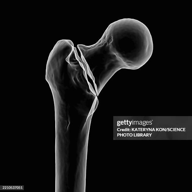 Basicervical 117 Femoral Fracture Stock Photos, High-Res Pictures, and Images ...